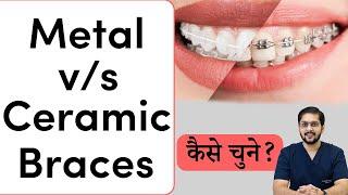 मेटल ब्रेसेस vs सिरेमिक ब्रेसेस: इनमें से क्या चुनें? | Which One to Choose? | Seraphic Dental