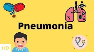 Pneumonia, Causes, Signs and Symptoms, Diagnosis and Treatment.