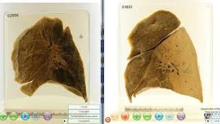 Lobar pneumonia vs Bronchopneumonia