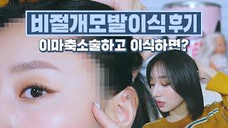 비절개모발이식 후기 이마축소술 후 이식 후기는 제가 처음 맞쬬? | 한 달차 과정