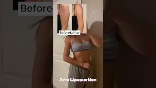 Arm Liposuction at Girin Plastic Surgery, Seoul