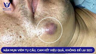 ĐIỀU TRỊ MỤN VIÊM TỤ CẦU, HIỆU QUẢ SAU 1 BUỔI, KHÔNG ĐỂ LẠI SẸO TẠI PHÒNG KHÁM DA LIỄU HHV CLINIC.