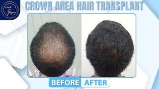 Crown Hair Transplant || Case Study and Result || Best Hair Transplant In India