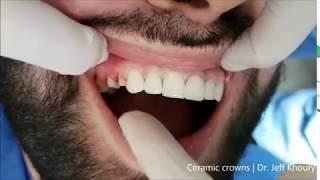 Hollywood Smile with ceramic zirconia crowns | Dentist Beirut Lebanon