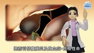 發燒、右上腹痛，膽囊炎怎麼辦？