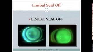 Get All Of Your Scleral Lens Questions Answered