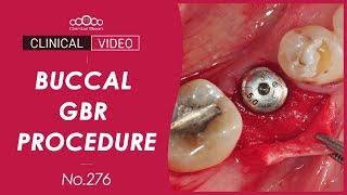 Simple buccal GBR with membrane punch [Dr. Kim Jaeyoon]