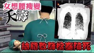 「腰瘦」變「夭壽」　女抽脂致肺栓塞險喪命 | 台灣蘋果日報