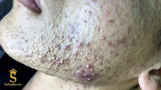 Best Pimple Popping P3 | Mụn Dậy Thì Siêu Hấp Dẫn P3 - SacDepSpa#183