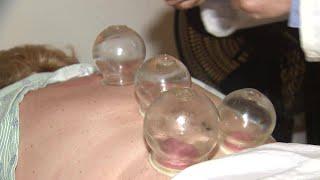 What are the health benefits of 'cupping?'