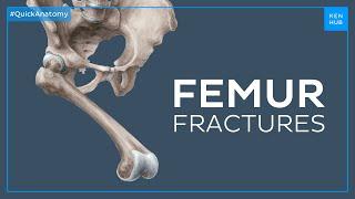 What happens when you fracture your femur - Quick Anatomy | Kenhub