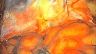 Intracranial blister aneurysms: clip reconstruction techniques