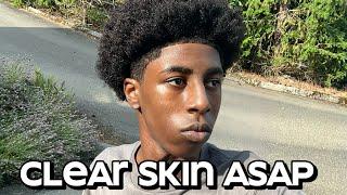 How To Get Clear Skin For Guys ASAP