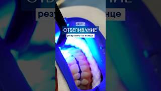 Отбеливание Зубов! Как вам результат? #стоматологиямосква #dentist #стоматолог