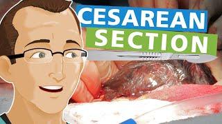 Cesarean Section