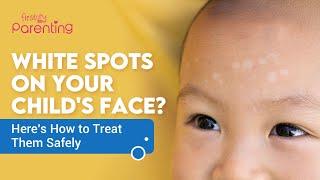 White Patches Or Spots On Child's Face - Causes and Treatments