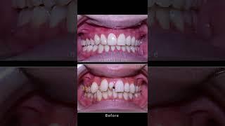 Niềng răng 24 tháng #braces