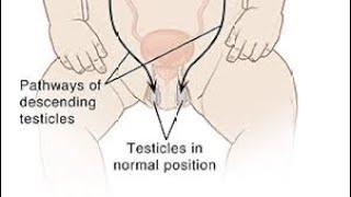 Undescended testis | dr Imran patel