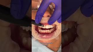 Composite Veneers | Step by Step