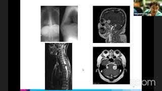 Mount Sinai Neurosurgery TeleRounds