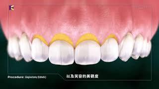 齒齦切除術（美觀因素）｜Dr. Eric Ma 馬永昌醫師