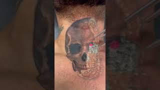 Laser tattoo removal on neck #shorts