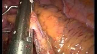 Laparoscopic Assisted Restorative Proctocolectomy for Familial Adenomatous Polyposis