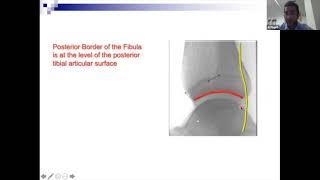 Fundamentals of Orthopaedics Session 15 Part 2 - Ankle Fractures