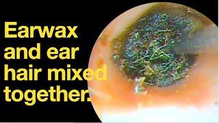 Earwax and ear hair mixed together.|ear wax removal | ear cleaning | ASMR | relaxation | relax