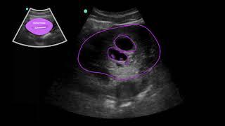 POCUS: 1st Trimester Pregnancy Case 3 - Twin Gestation 6w5d