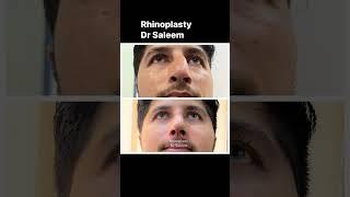 Rhinoplasty surgery before & after by dr Saleem.#rhinoplasty