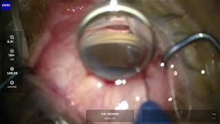 Hydrus stent surgery explained