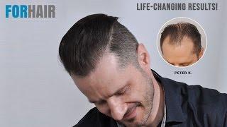 FUE Hair Transplant Result - Patient Review - 3957 Grafts - Forhair