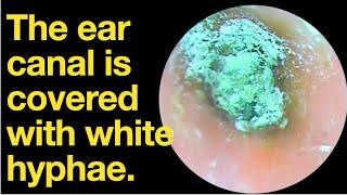 The ear canal is covered with white hyphae.|ear wax removal | ear cleaning | ASMR | relaxation |