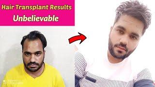 Perfect hair transplant results in just 6 months at very affordable cost |HT case study