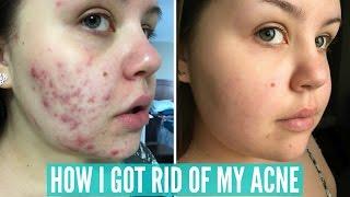 HOW I CLEARED UP MY SEVERE ACNE | SariReanna