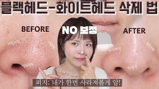 +) 제발 코 피지 짜지 마세요!!NO보정-속이 다 시-원한 피지 없애는 법 블랙헤드&화이트헤드 제거