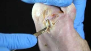 Debridement of a diabetic foot ulcer