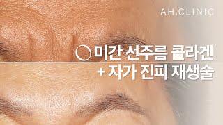 깊은 미간 주름 고민 끝! 미간 선주름 콜라겐 주사 + 자가진피재생술 