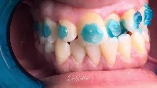 تركيب تقويم الاسنان قبل وبعد #dr_abdullah_sultan_dentist