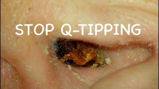 STOP Q-TIPPING!!  EAR WAX PLUG REMOVAL : 4K HD