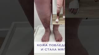 Как мы вылечили трофическую язву и она больше не появляется! Флеболог Якушкин.#трофическаяязва