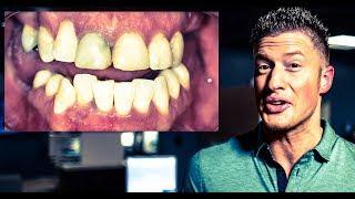 INVISALIGN, IMPLANTS, and Dental VENEERS - from PUERTO RICO for a SMILE! Cosmetic Dentistry (EP 3)