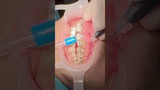 Laser #gingivectomy to treat the swelled gum during #bracestreatment and to correct the #gummysmile