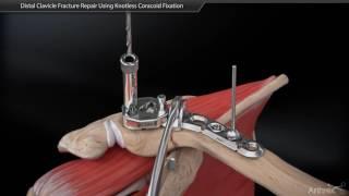 Distal Clavicle Fracture Repair Using Coracoid Fixation