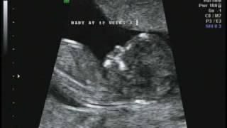 12 weeks 1 day Ultrasound