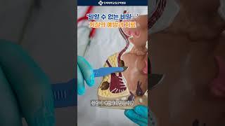 [1분 건강백서] "말할 수 없는 비밀" 치질의 예방과 치료│일산백병원 외과 최평화 교수