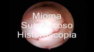 Mioma SubMucoso Histeroscopia