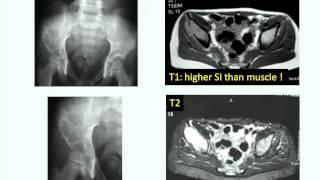 BONE TUMOR IMAGING