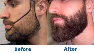 Hair Transplant Before and After - Month by Month results Elithair